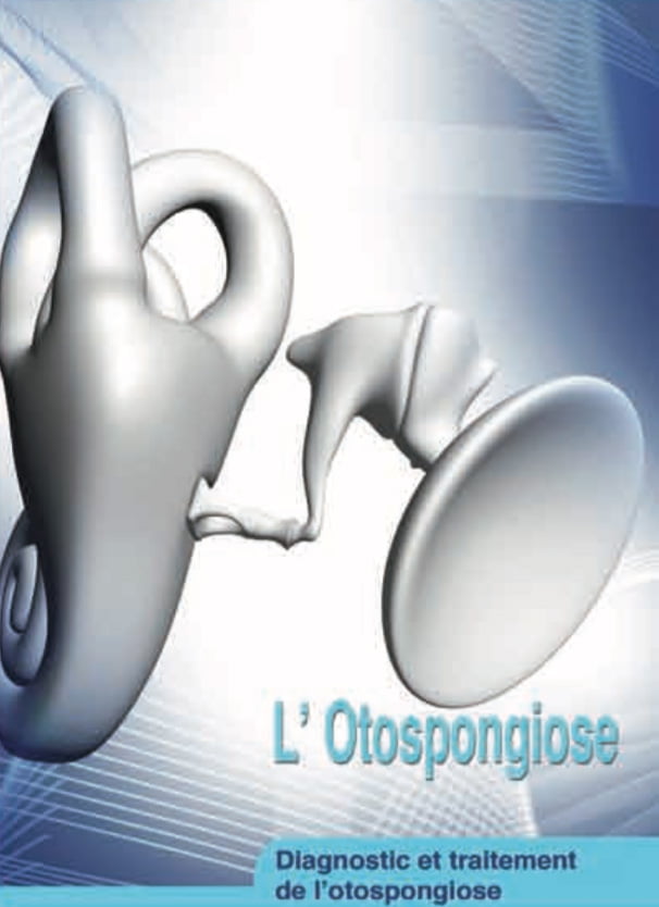 Otospongiose